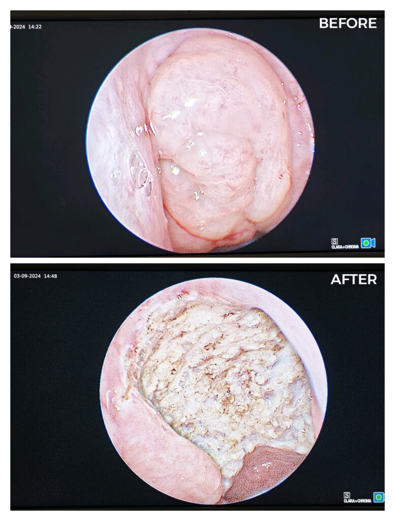Before and after images of a colonoscopy procedure, highlighting the differences in colon health. ENT Dubai.