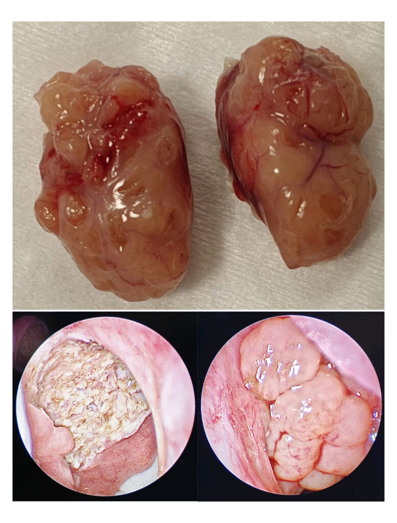 Liver images showing a tumor, relevant to pediatric ENT practices surgery and ENT doctor in Dubai.
