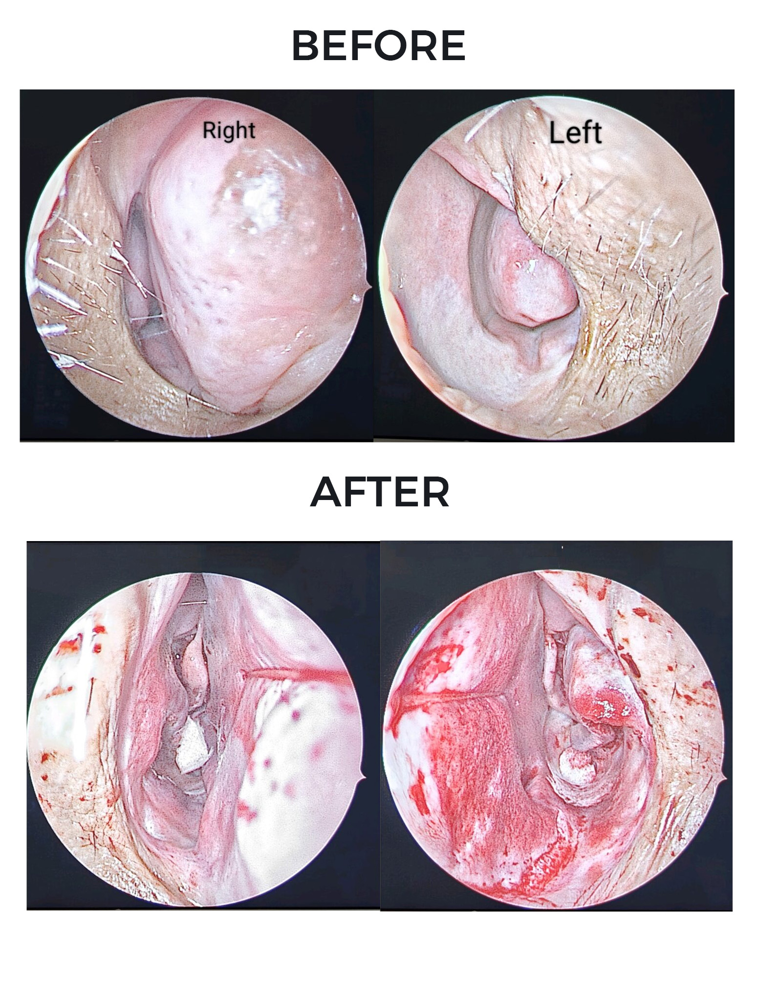 Before and after images of a patient treated for a large tumor by an ENT specialist in Dubai, showing significant improvement.