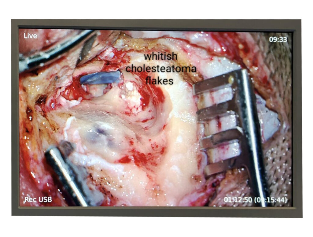 Cheetah tooth extraction by Whistler, showing whitish cholesteatoma flakes, performed at ENT Dubai.
