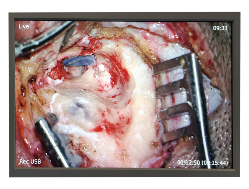 An endoscopic surgery scene featuring a scalpel and scissors, performed by an ear doctor in Dubai.