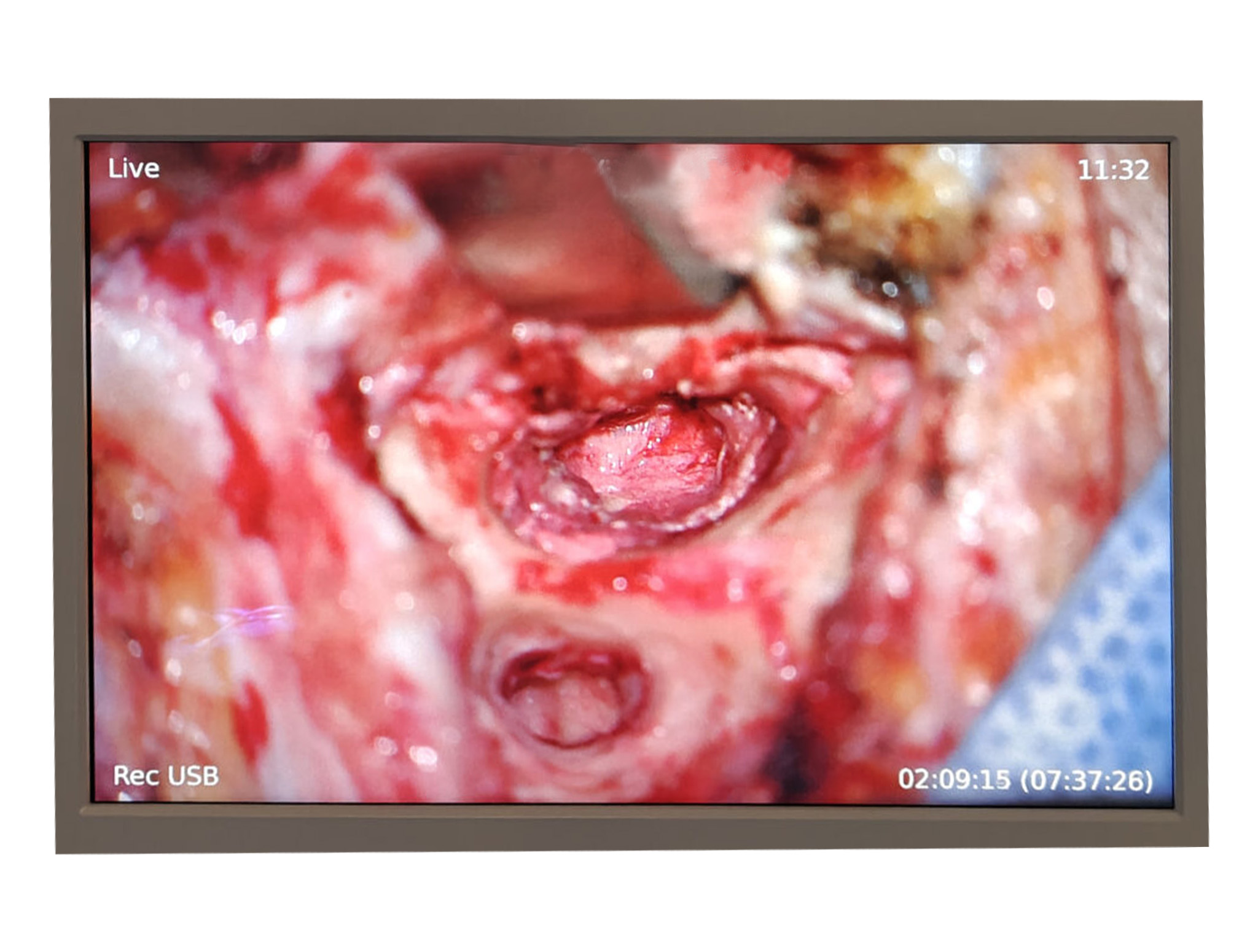 Small wound on the side of the stomach, possibly related to a medical condition, relevant for an ear specialist in Dubai.