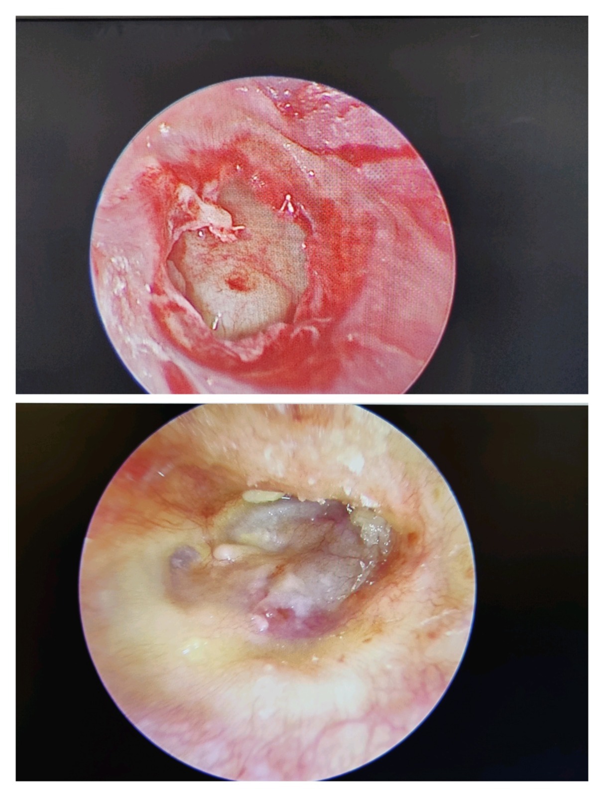 Two images showing a small hole in the ear, illustrating details of micro ear surgery.