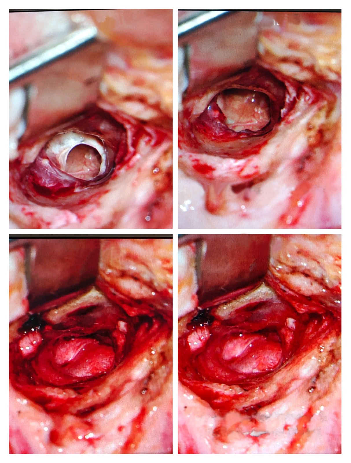 Four images depicting the stages of a wound healing process after micro ear surgery in Dubai.