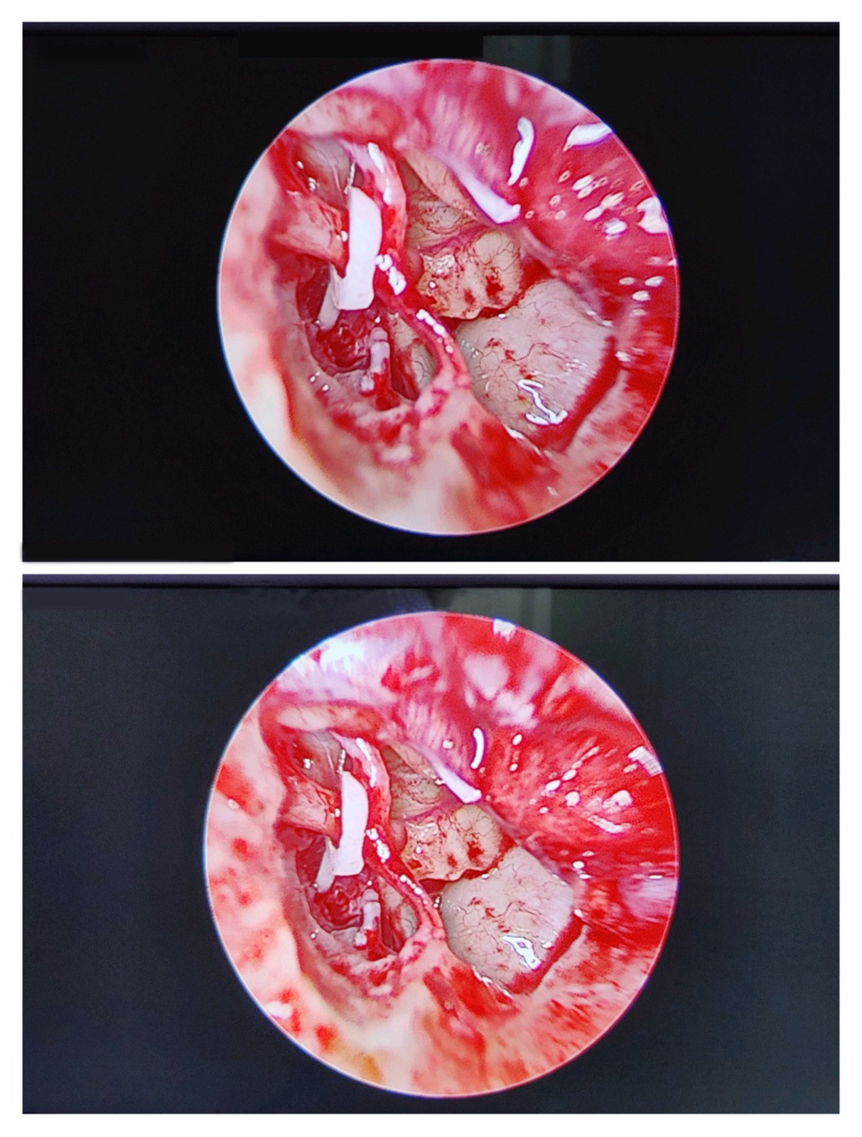 Two images of a small piece of red tissue, related to micro ear surgery by an ENT doctor in Dubai.