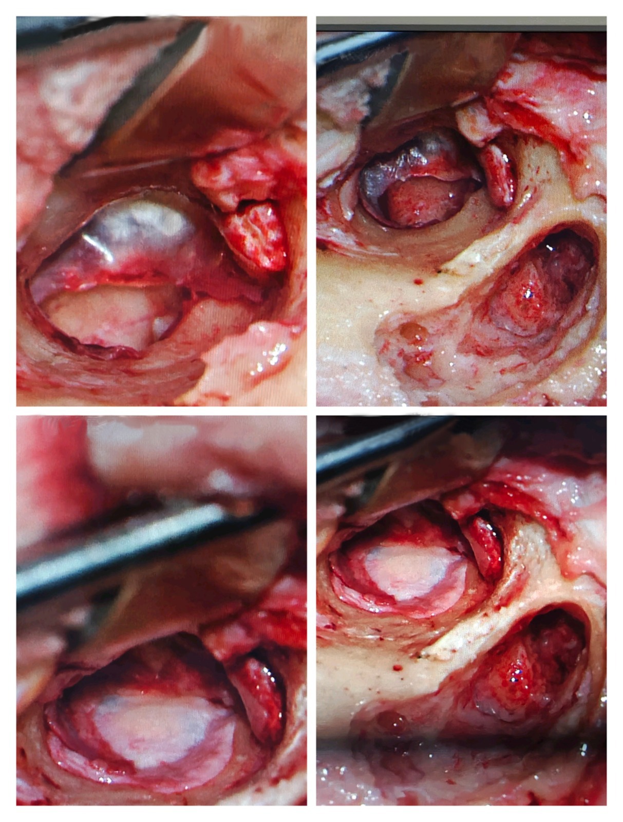 Four images depicting the stages of an open wound from micro ear surgery, showcasing healing progress in ENT procedures.
