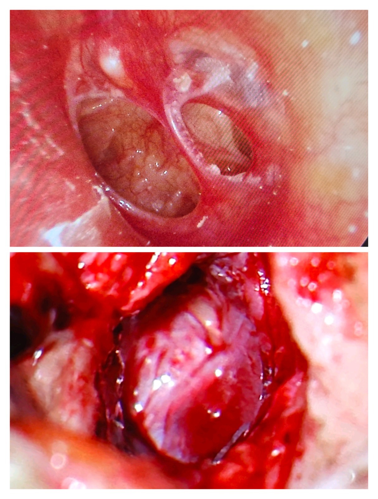 Small hole in the stomach shown in two images, related to micro ear surgery in Dubai.
