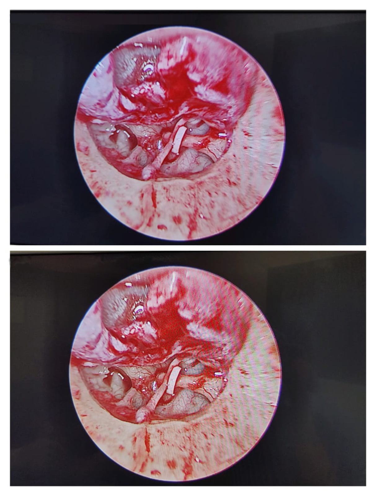 Small piece of meat being cut into pieces, illustrating precision in micro ear surgery by an ENT doctor in Dubai.
