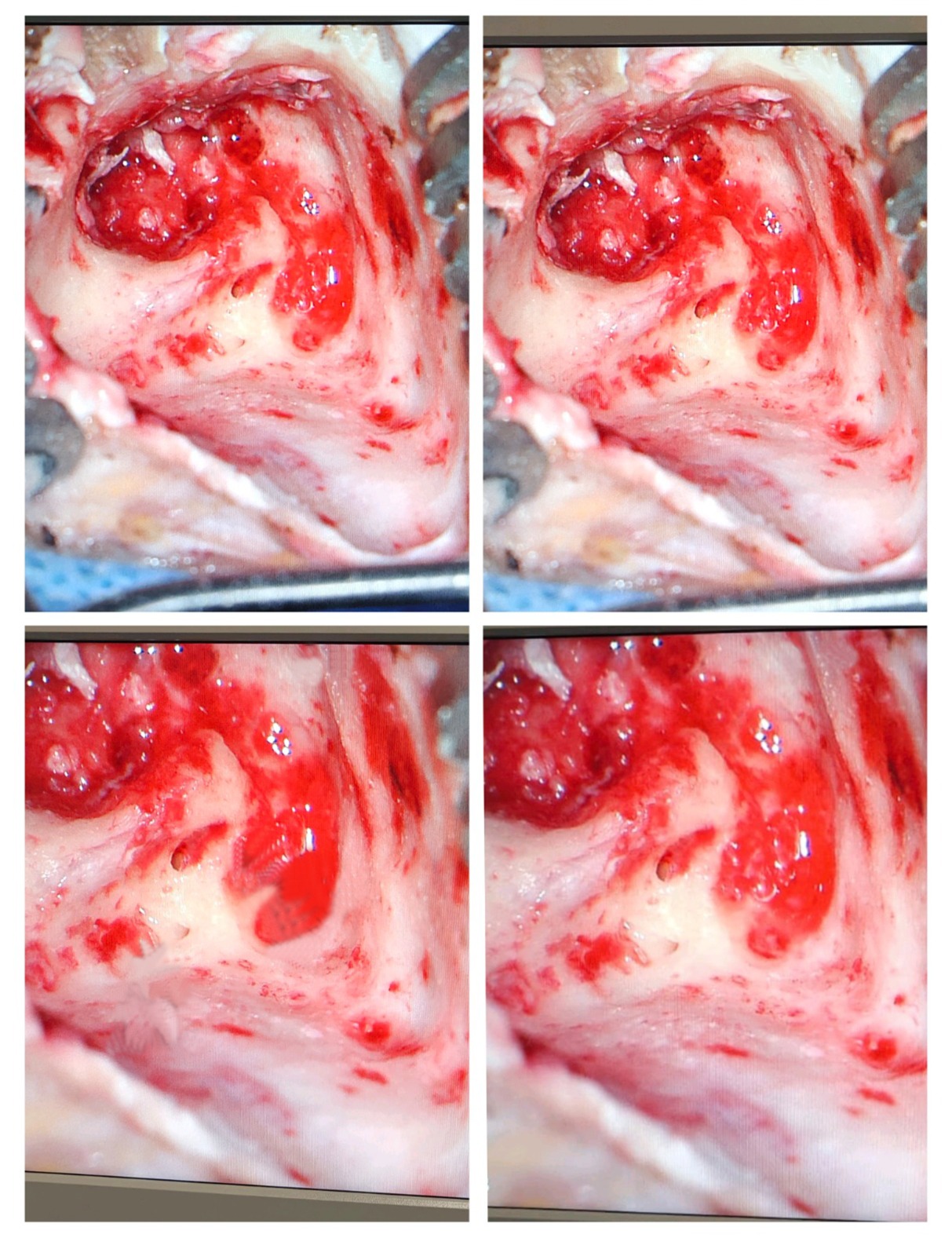Two images showing a small surgical hole in the stomach, related to micro ear surgery by an ENT doctor in Dubai.