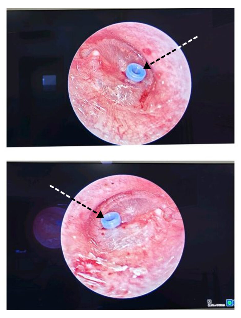 Small skin hole images related to pediatric ENT surgery by an ear specialist in Dubai.