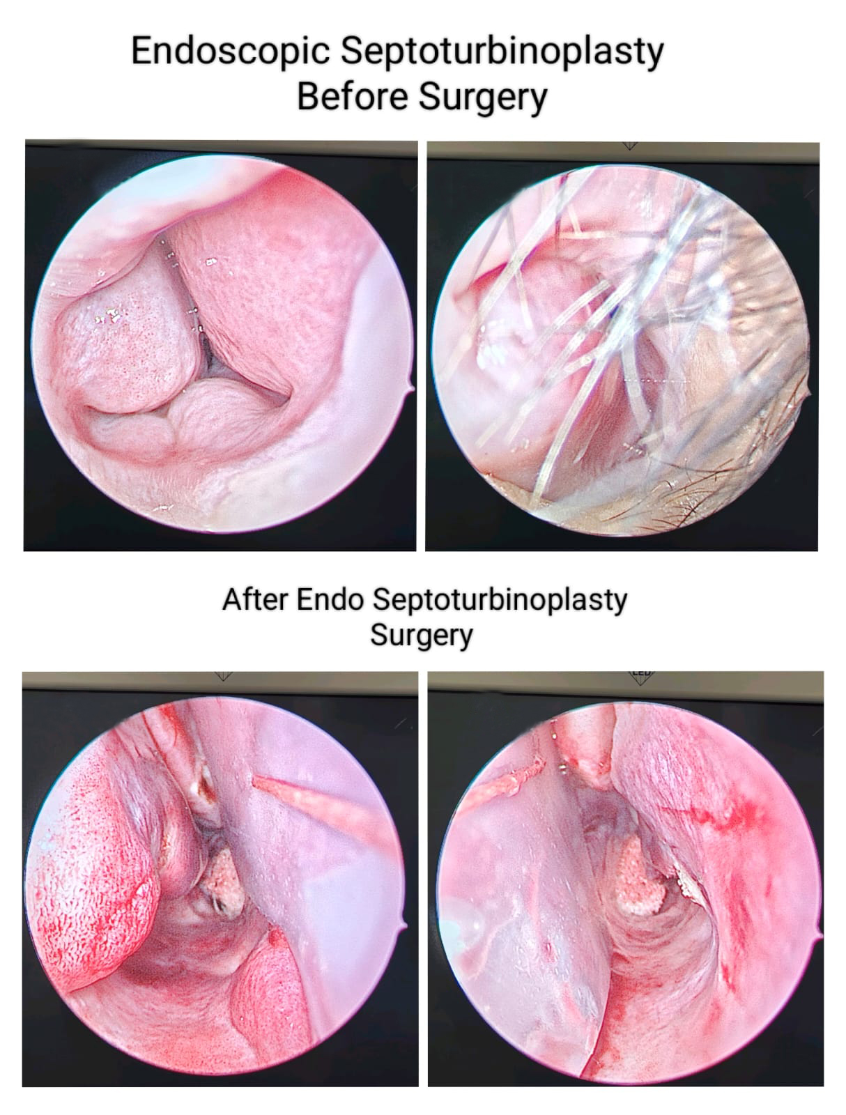Endoscopic septalotomy surgery results, showcasing before and after images by an ENT specialist in Dubai.