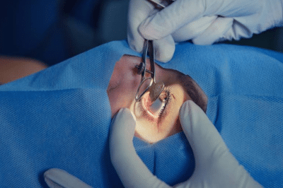 A Complete Guide to Tear Duct Blockage and DCR Surgery