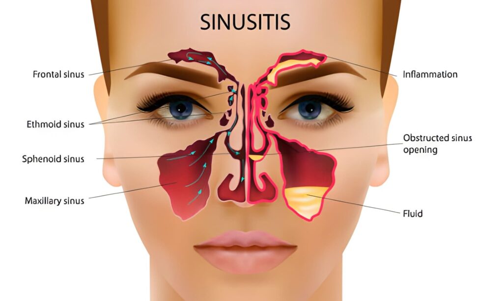 cute vs Chronic Sinusitis Treatment in Dubai