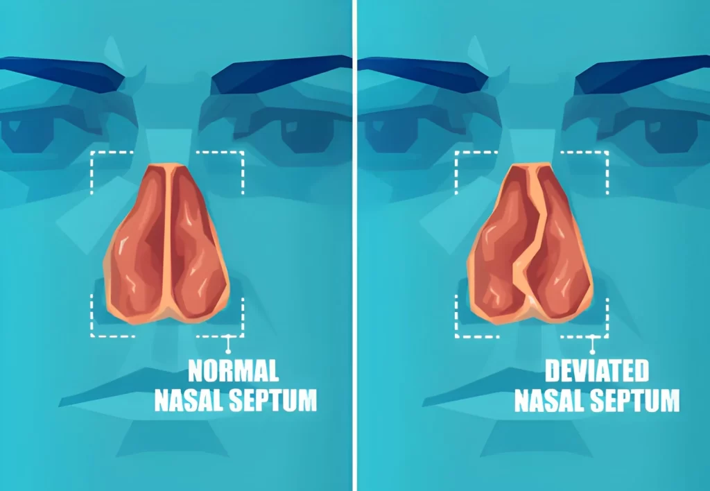 Deviated Septum Treatment in Dubai