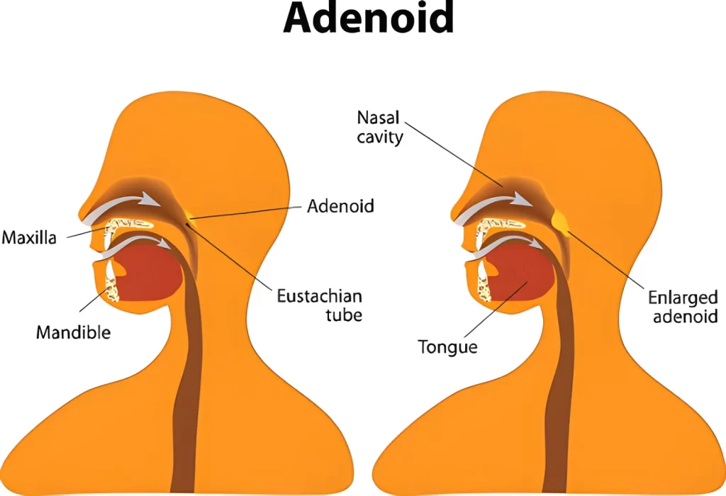 Adenoidectomy surgery Dubai