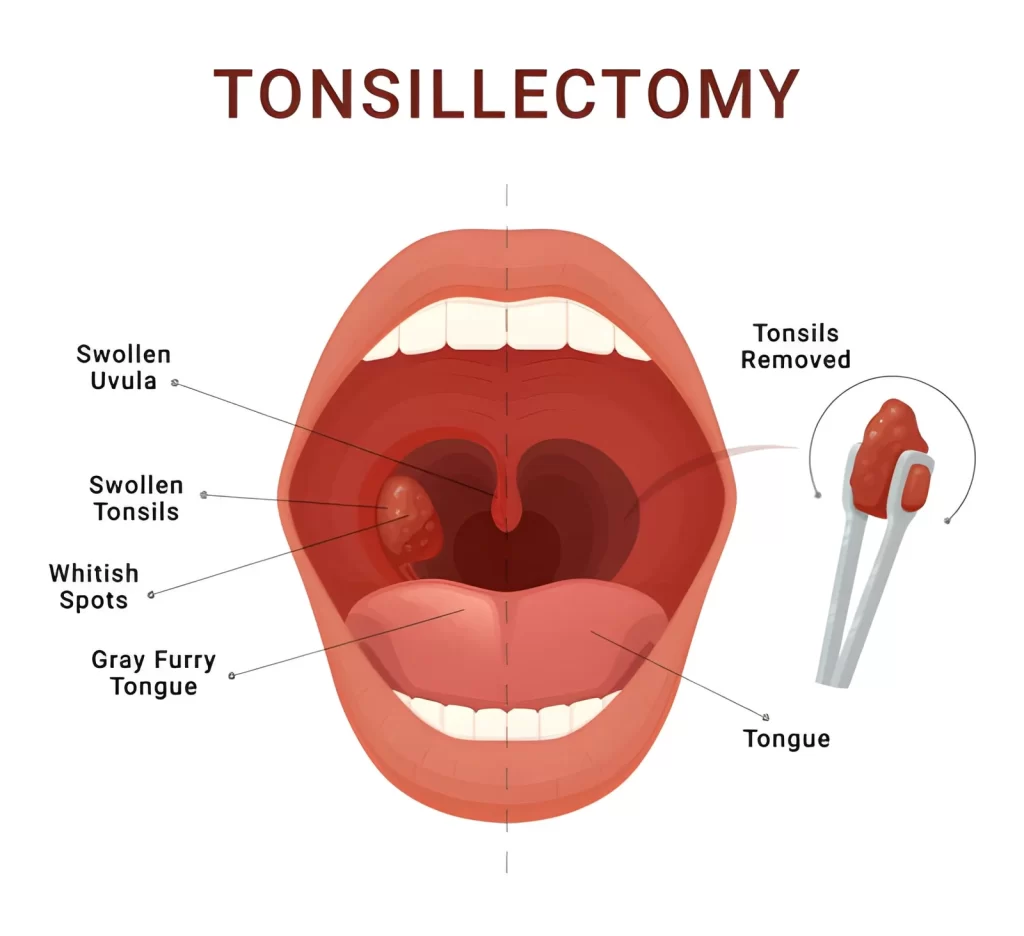 Tonsillectomy Surgery in Dubai
