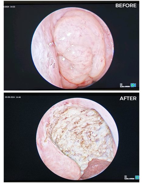 Before and after images of a colonoscopy procedure, highlighting the differences in colon health. ENT Dubai.