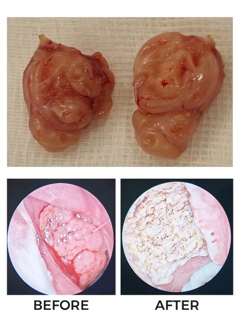 Before and after images of a tumor, showcasing results from pediatric ENT surgery in Dubai.