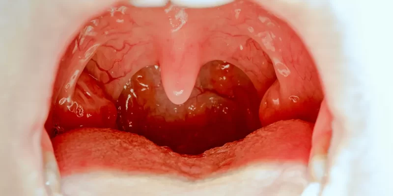 Tonsillectomy Surgery